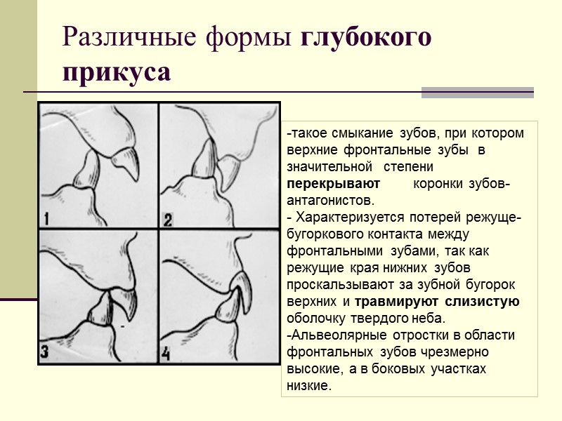 Различные формы глубокого прикуса  такое смыкание зубов, при котором верхние фронтальные зубы 